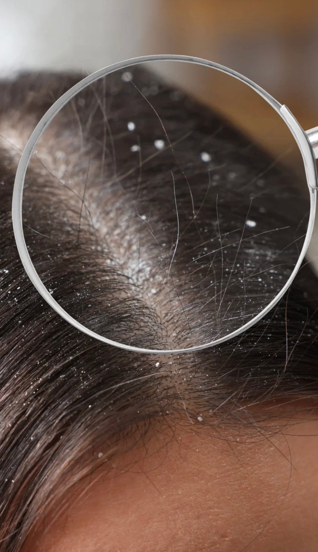 Pellicules sèches vs pellicules grasses - comment les reconnaître et s’en débarrasser ?